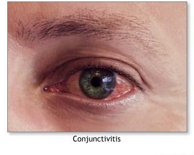 conjunctivită virală oftalmolog
