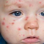 bebe_varicela