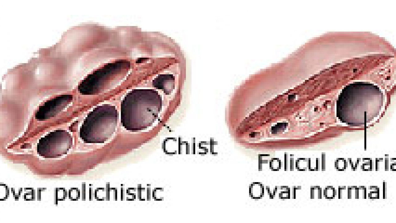 Cat De Periculoase Sunt Chisturile Ovariene Doctorul Zilei