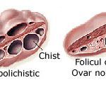 sindromul-ovarelor-polichistice
