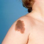 congenital_nevus