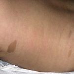 dermnet_photo_of_cafe_au_lait_spot