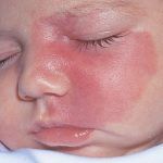 _port-wine_stain_on_infant