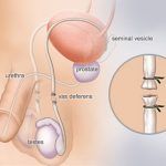 vasectomie