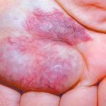 venous_malformation_on_hand