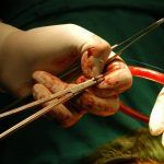 10operatii transplant foto ramona balutescu01