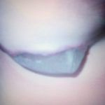 Lauren-Yardley-leaking-scar