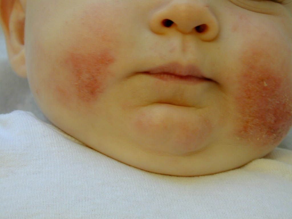 hole Defeated George Hanbury 20% dintre copii suferă de Dermatită Atopică. Află totul despre această  afecţiune