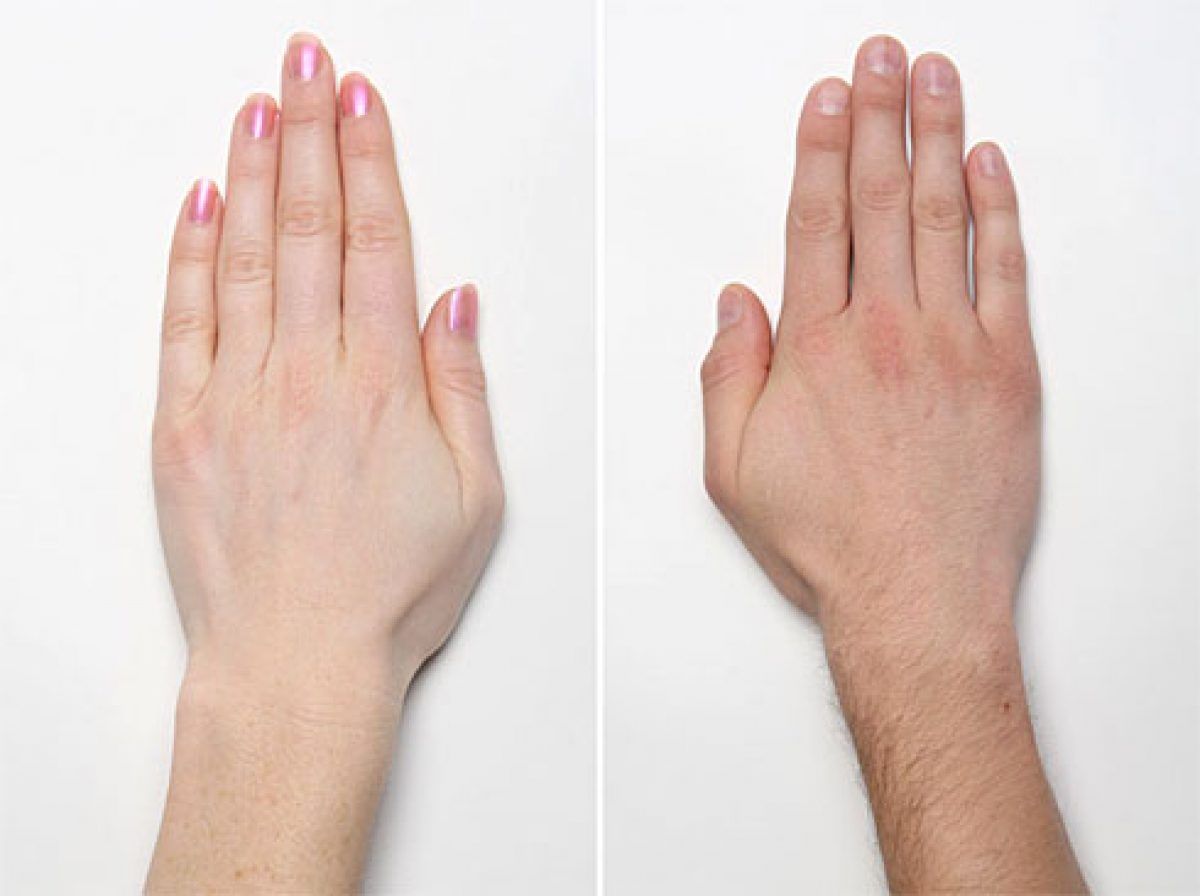 osteoartrita deformatoare a degetelor