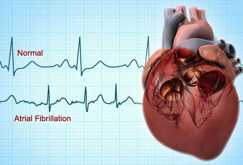 boală la pacienții diagnosticați cu fibrilație atrială