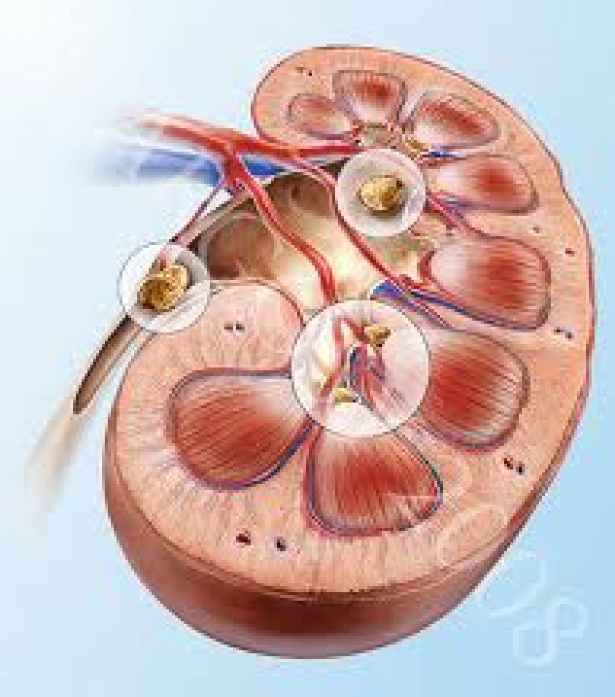 nisip rinichi infectie urinarae colitratament homeopat