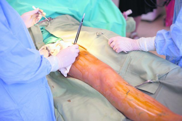 Operație varice deschisă - Clinica Zetta