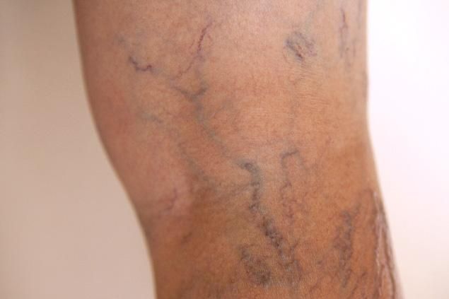 operaiile varicoze dureaza puternic piciorul ce semne de varicoza în cavitatea abdominala