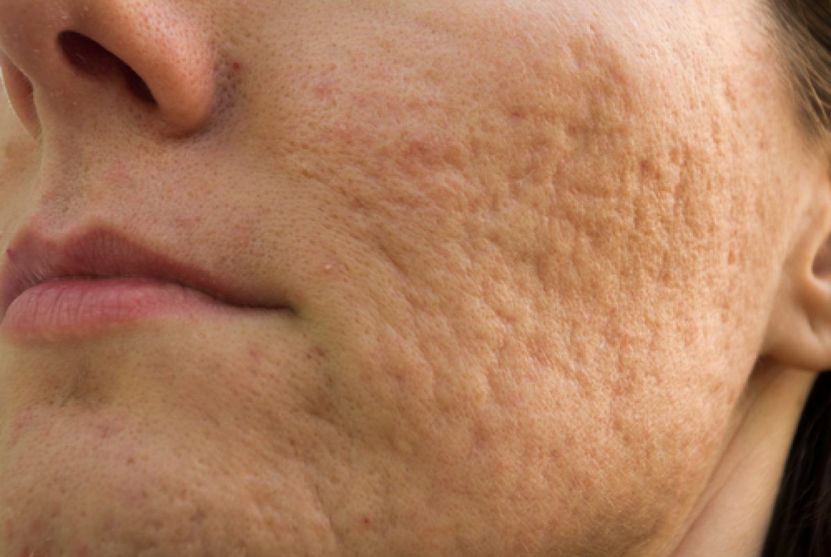 Remedii naturale pentru acnee. Masti faciale naturale pentru cosuri