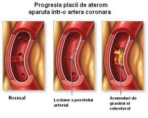 Ateroscleroza-Progresia-placii-de-aterom-intr-o-artera-coronara