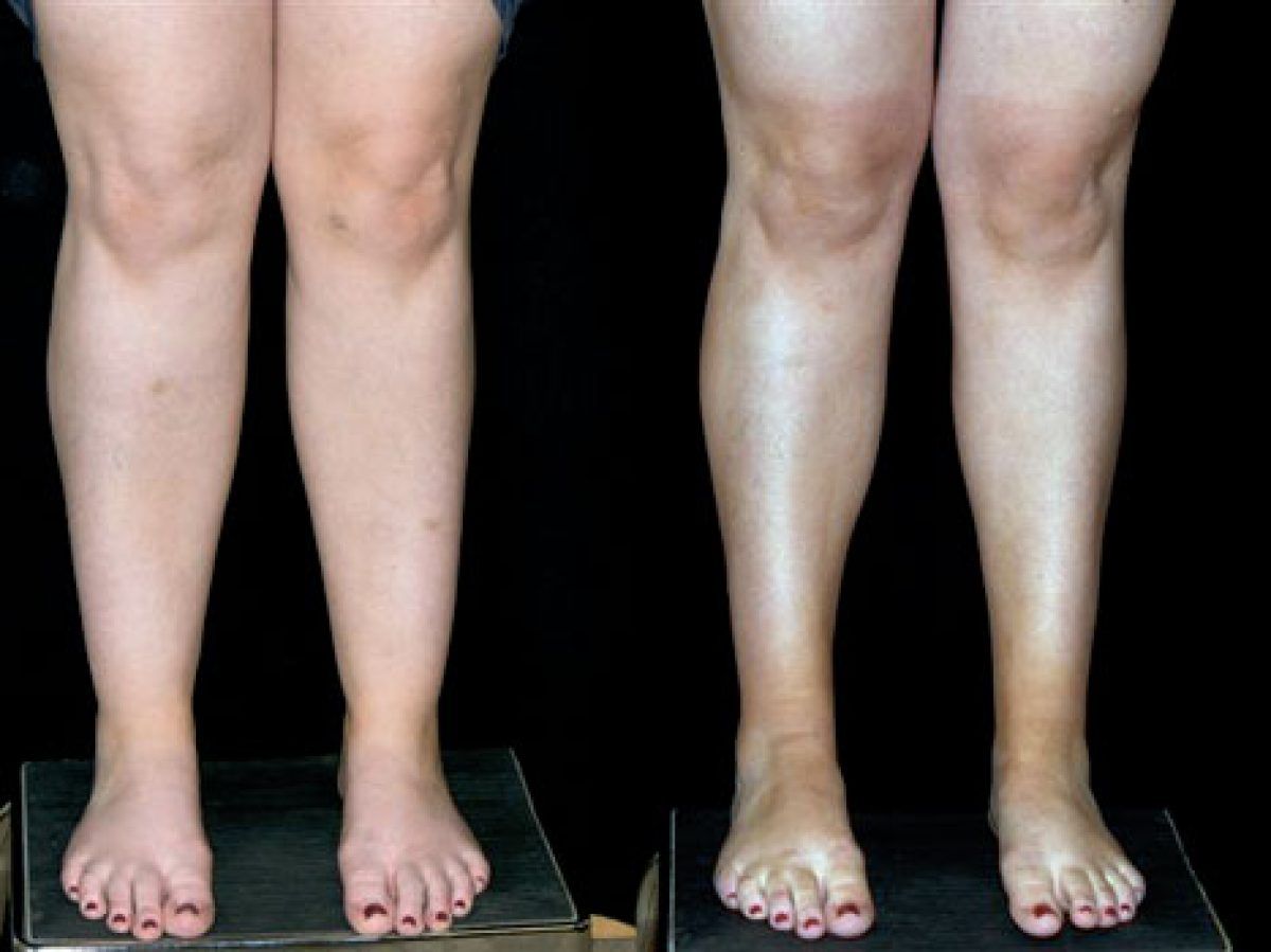 Exerciții pentru subțierea picioarelor De ce avem picioare groase?