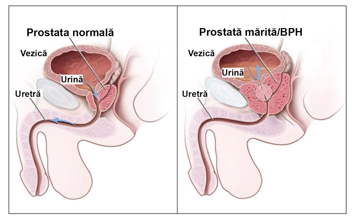 Prostata, boala care afecteaza sanatatea barbatilor