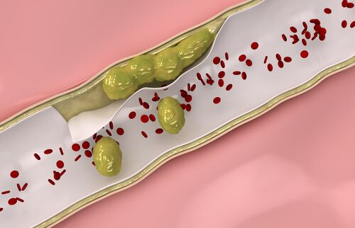 Desfundarea vaselor de sange la picioare