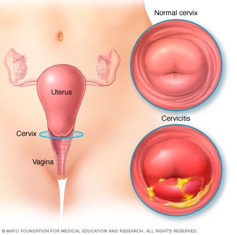 papilom uman al colului uterin pastila parazit curs