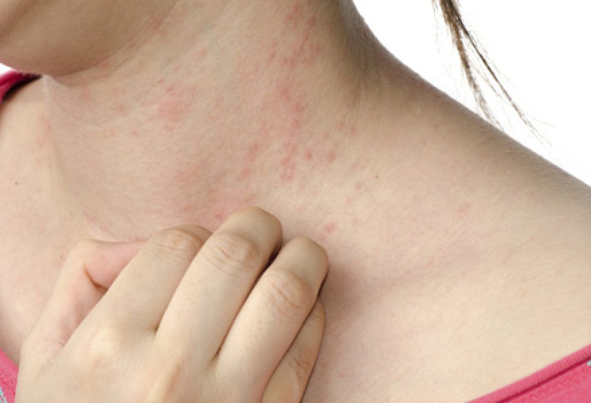Eczema Dishidrotică Pe Degete - Simptome și Tratament | Boli și diagnostice 