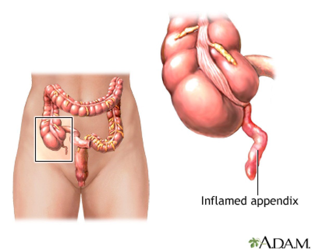 suspiciune de apendicită