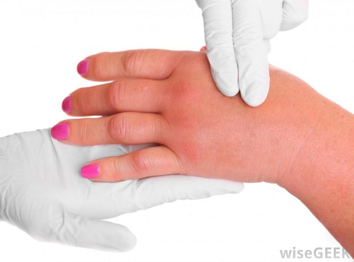 Umflarea articulațiilor în degete și degetele de la picioare faceți