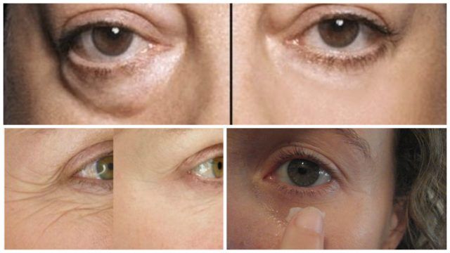 Cum să elimini ridurile de sub ochi: cele mai bune remedii cosmetice și populare