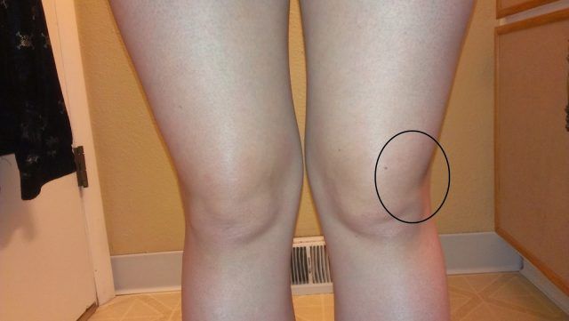 Apa la genunchi – simptome, cauze si tratament
