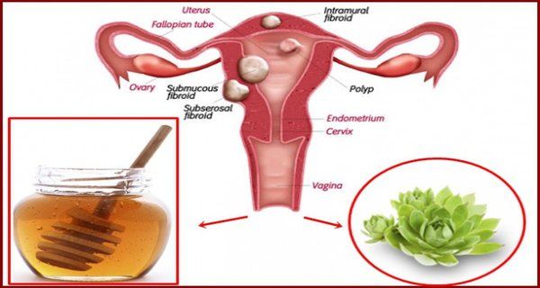 Așa Scapi De Chisturi Ovariene și De Fibroame Fără Medicamente