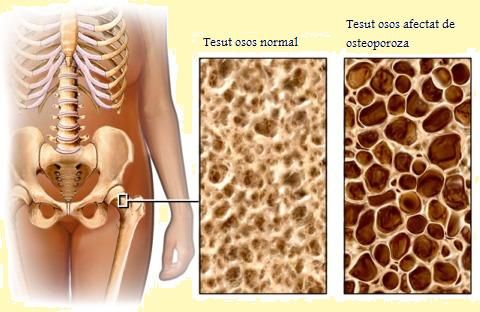 obiceiuri care cresc riscul de osteoporoza