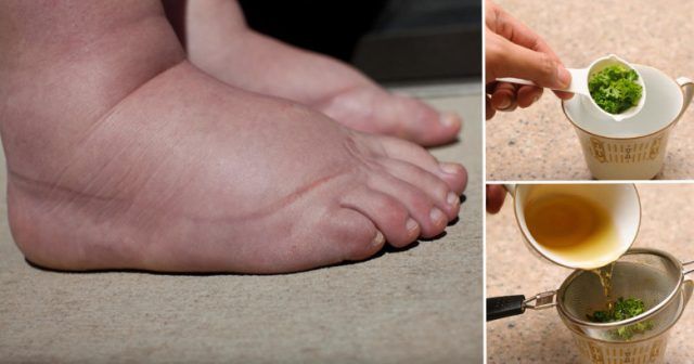 picioarele sunt umflate din cauza prostatitei prostata afecteaza viata sexuala