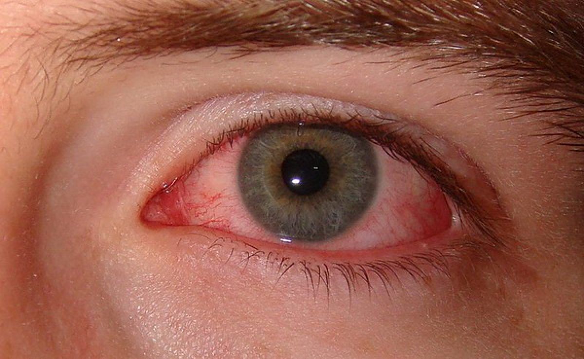 Ochi uscat – sindromul de ochi uscat