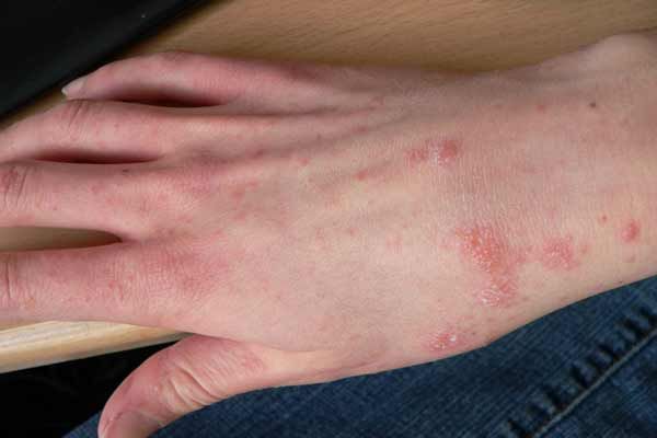 dureri articulare și musculare mâncărime a pielii