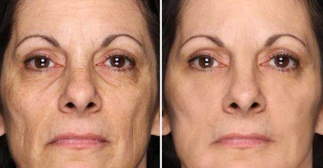 Lifting facial, anti-aging, curatare faciala si anti-rid