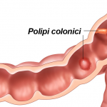 Polipi-Colon
