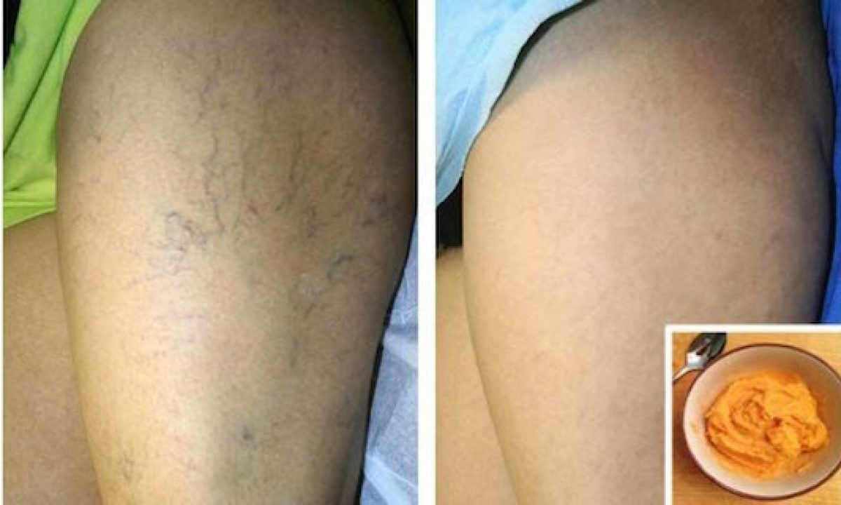 cum să se ocupe de vene varicoase recenzii ale tratamentului cu laser varicose