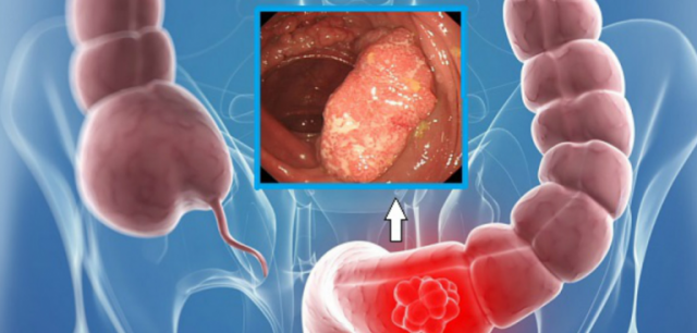 simptome in cancerul de colon