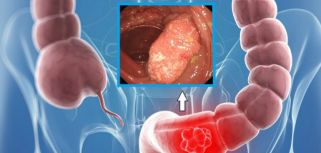 Cancer de colon: 13 informații esențiale, indiferent de vârstă