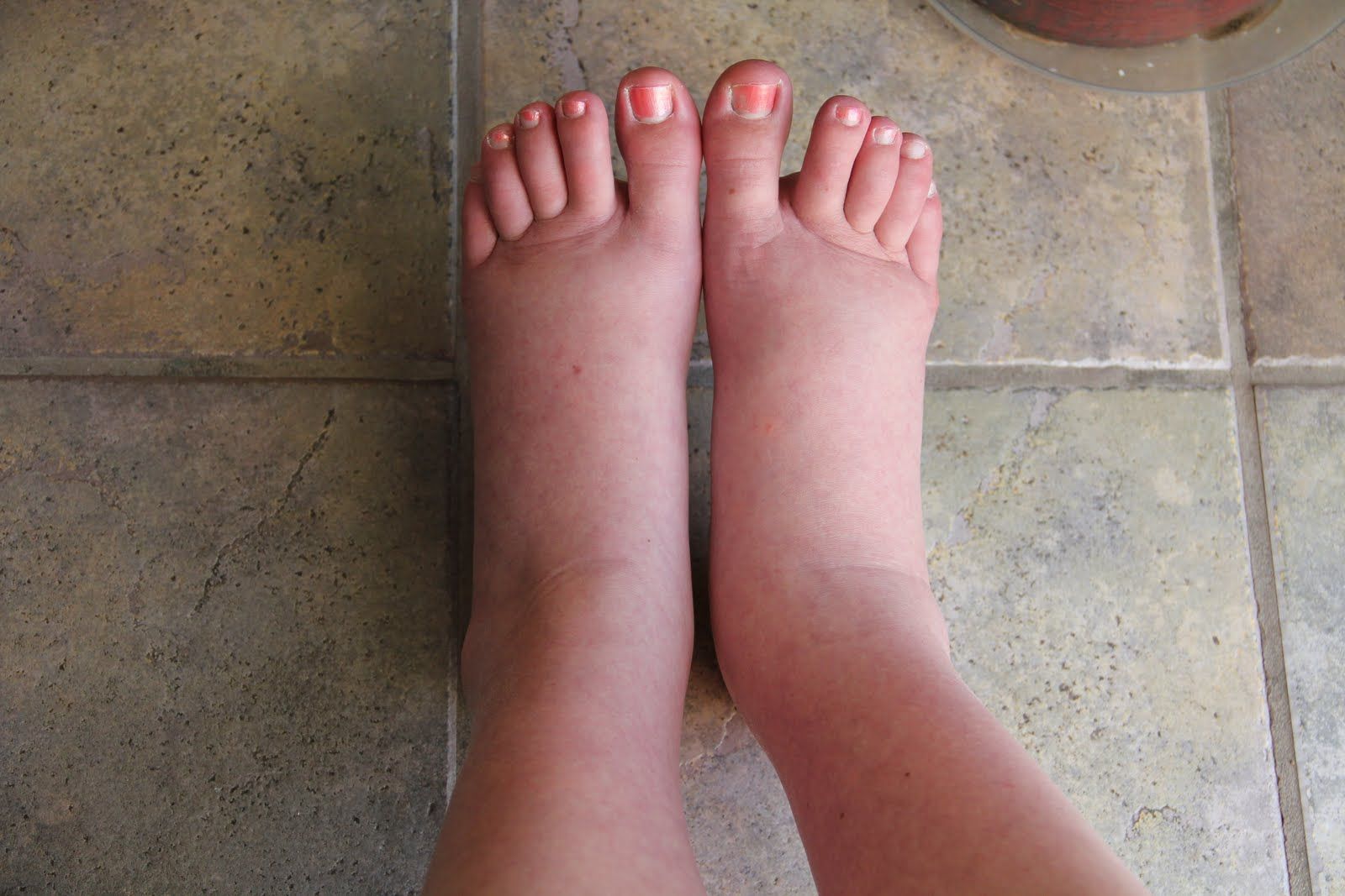 Picioare umflate - cauze, prevenire si tratament