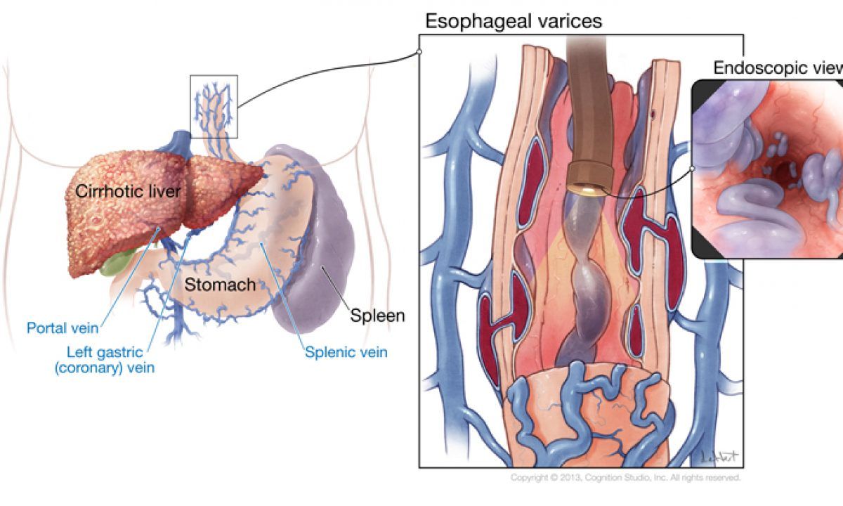 varice-simptome-cauze-preventie-tratament