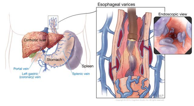 sclerozarea varicelor esofagiene