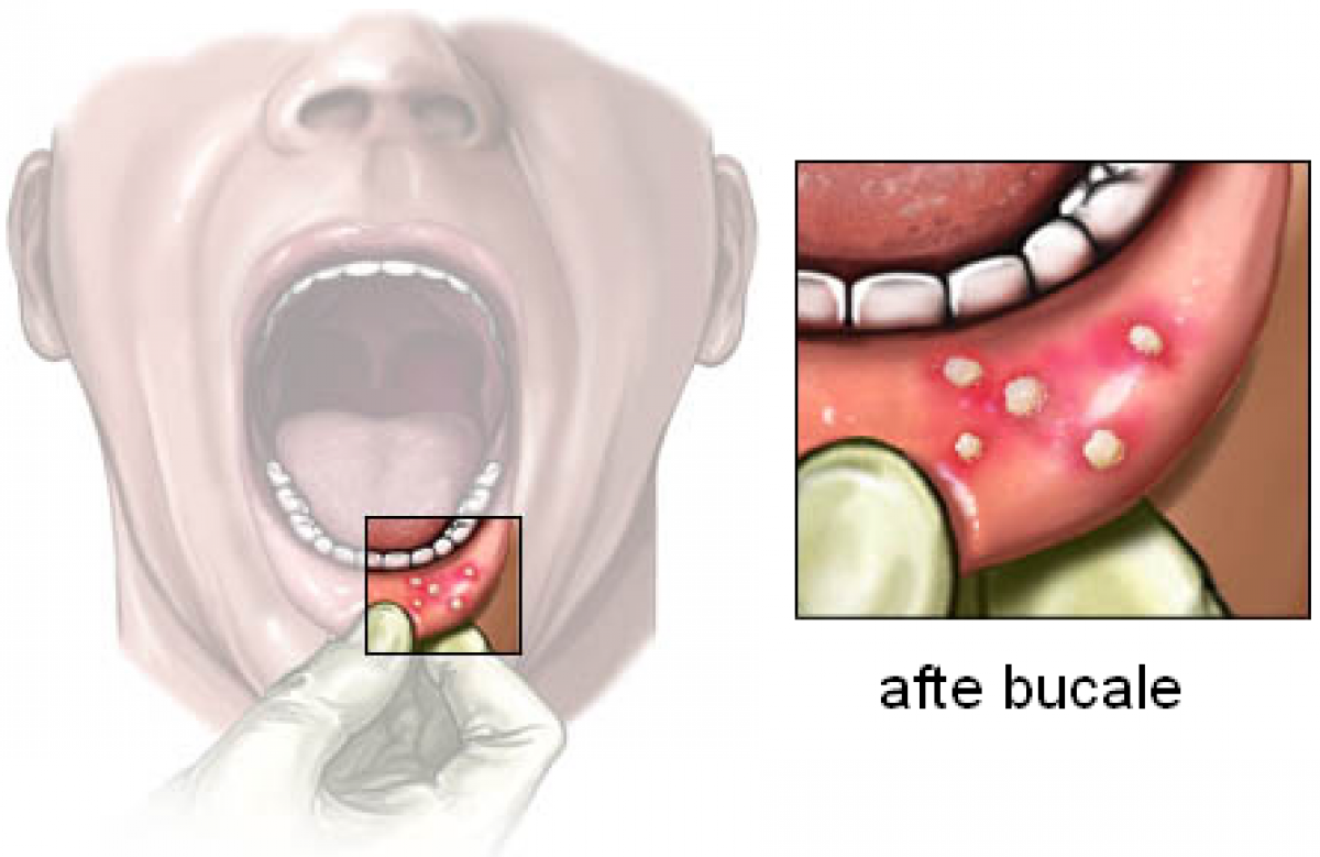 ulcerații bucale și dureri articulare