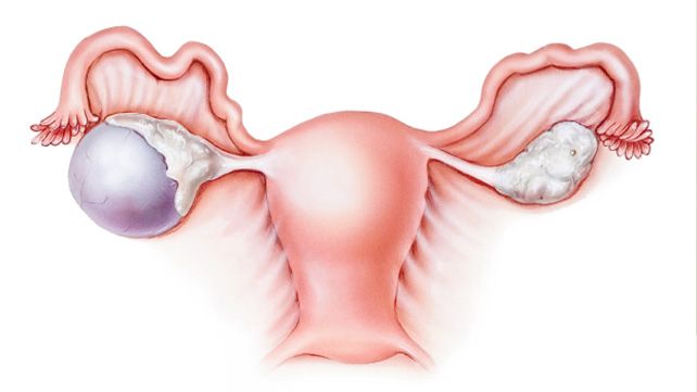 Cancer ovarian - Tot ce trebuie să ştii | Cancer Cancer ovarian se poate transmite