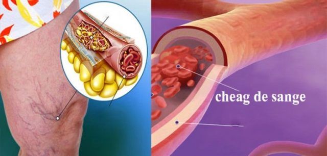 Sange in sperma (hematospermie) | Dr. Marcel Rad