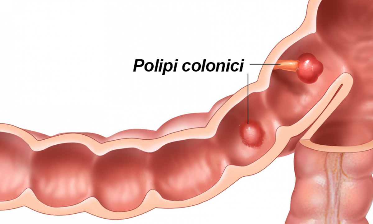 polipii de colon poate provoca pierderea în greutate