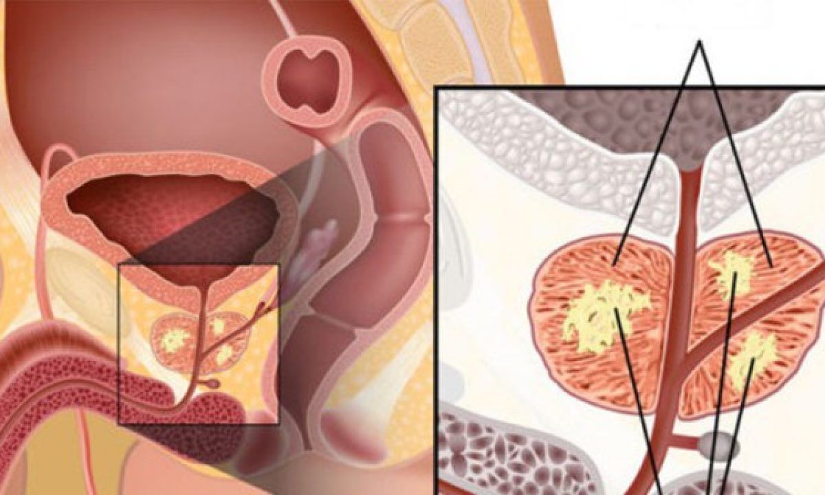 cancer prostate : symptômes