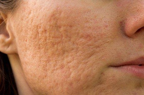 Cicatrici acnee - Laser cu CO2
