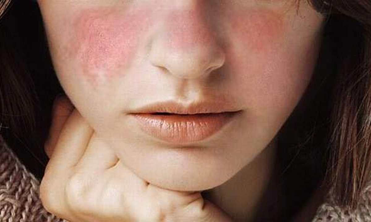 pierde greutatea atunci când aveți lupus