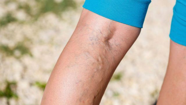 stocul de varicoză a venelor pe mâini din cauza a ceea ce apare picioarele varicoase