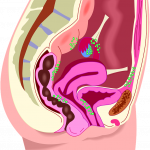 endometriosis-2634698_960_720